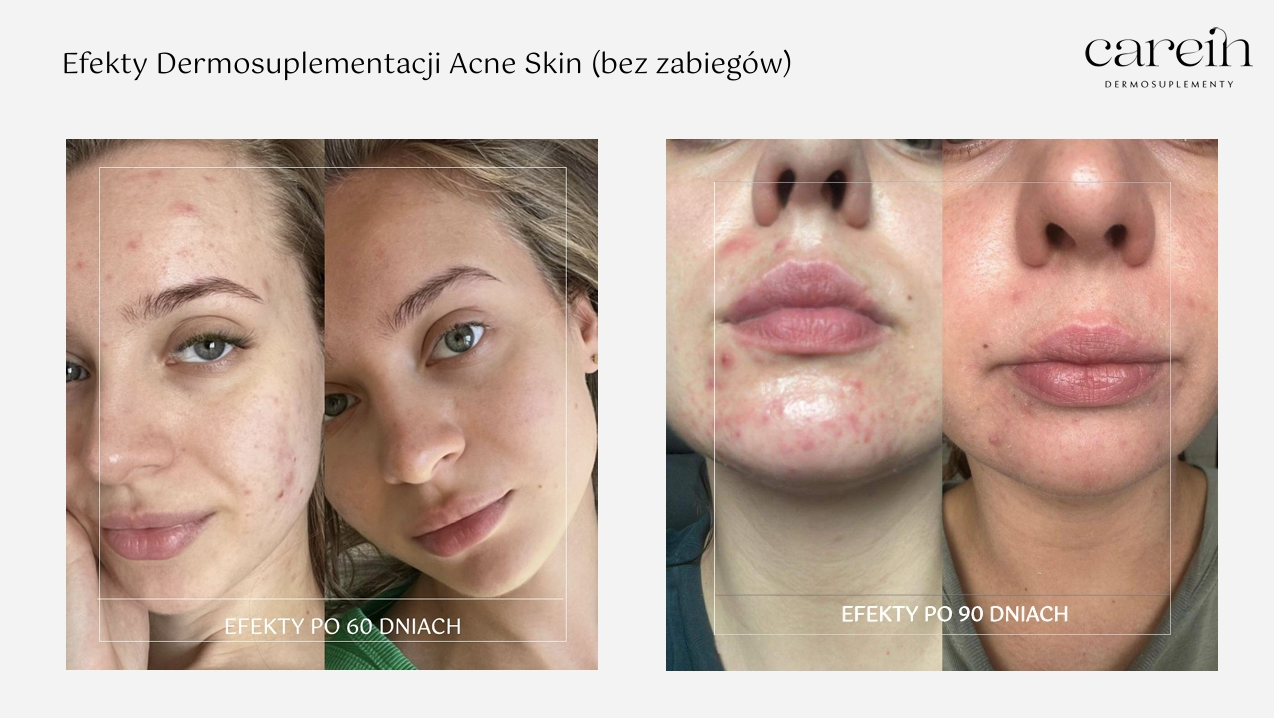 Acne Skin - Efekty bez zabiegów