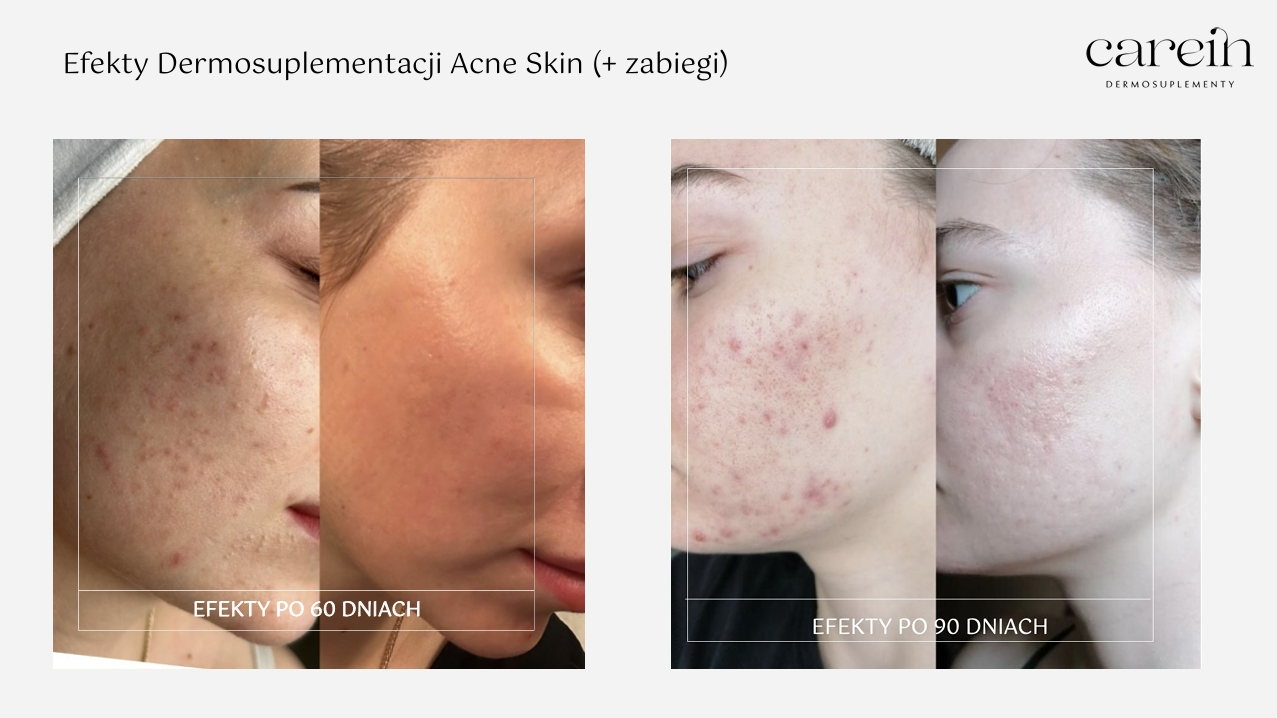 Acne Skin - Efekty z zabiegami