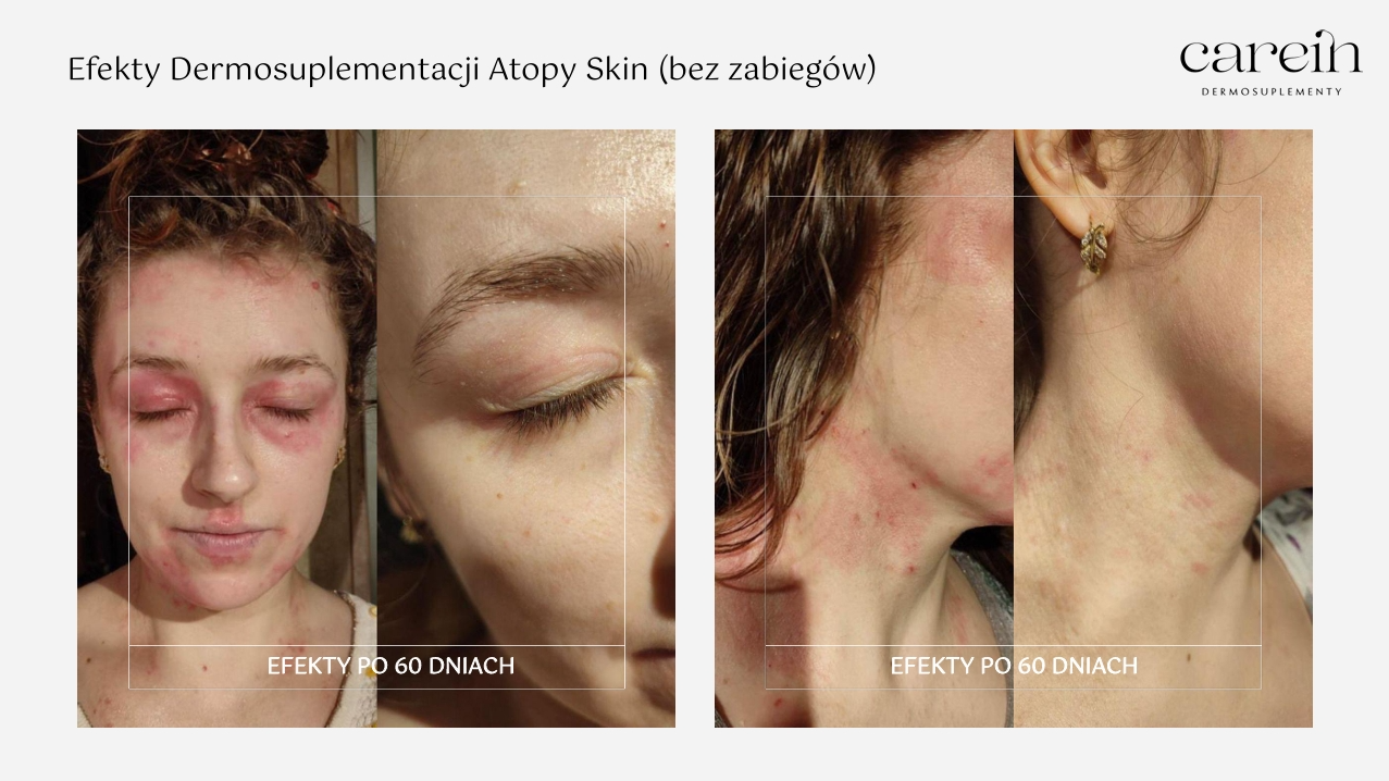 Atopy Skin - Efekty bez zabiegów