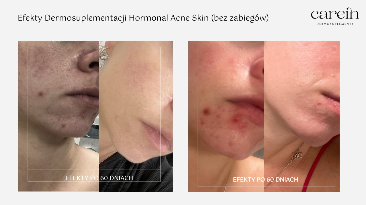 Hormonal Acne Skin - Efekty bez zabiegów