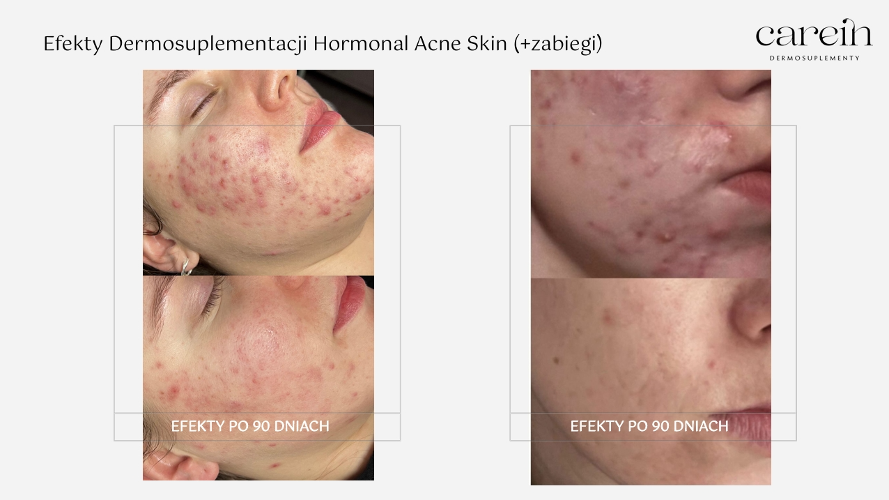 Hormonal Acne Skin - Efekty z zabiegami
