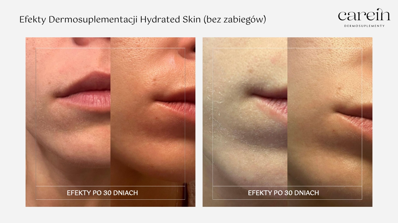Hydrated Skin - Efekty bez zabiegów