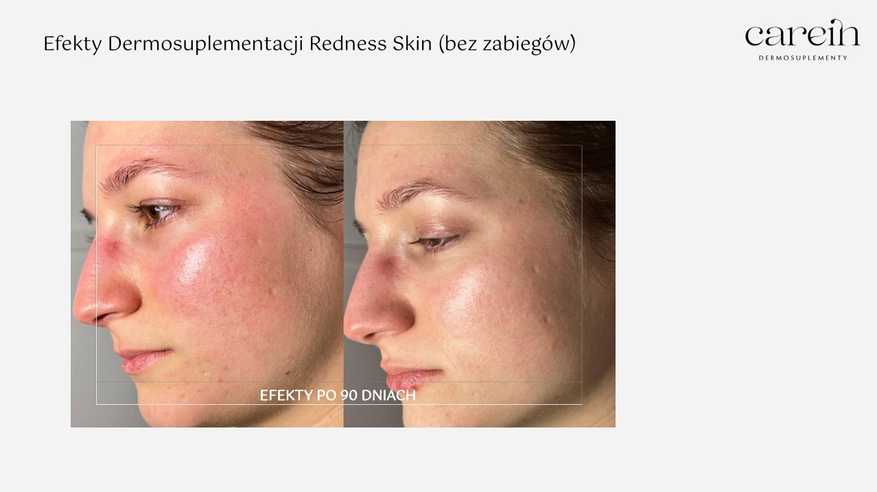 Redness Skin - Efekty bez zabiegów