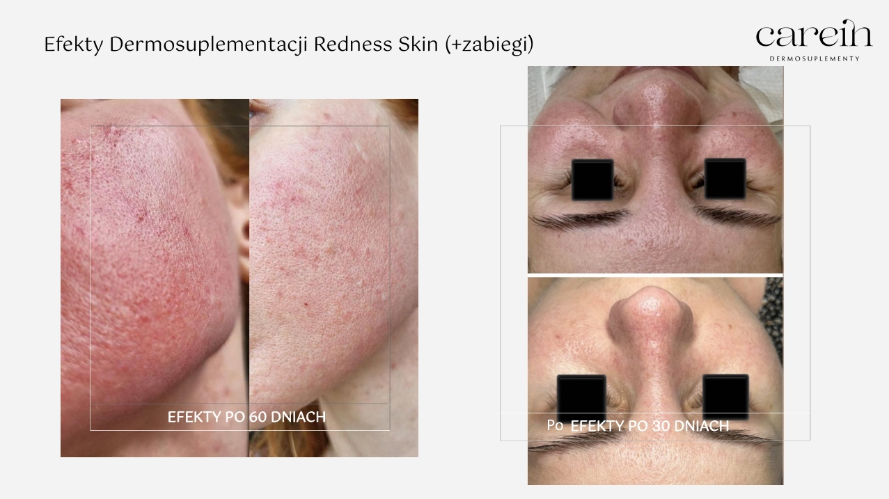 Redness Skin - Efekty z zabiegami