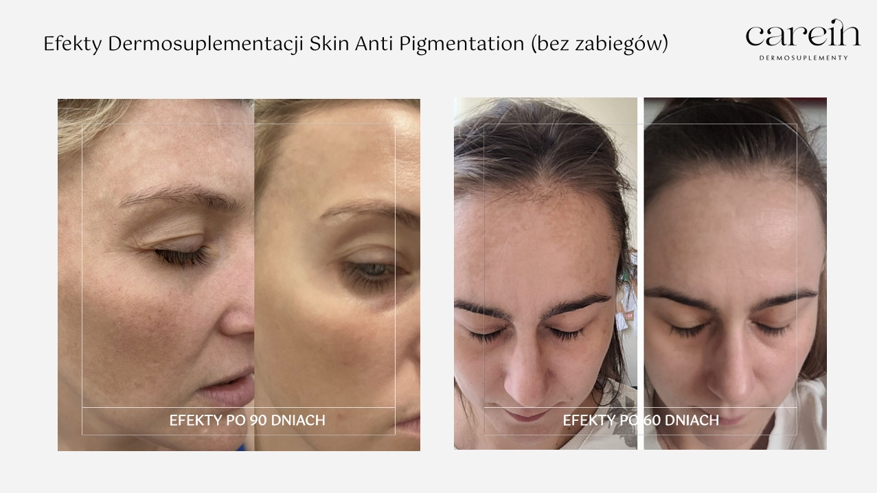 Skin Anti Pigmentation - Efekty bez zabiegów