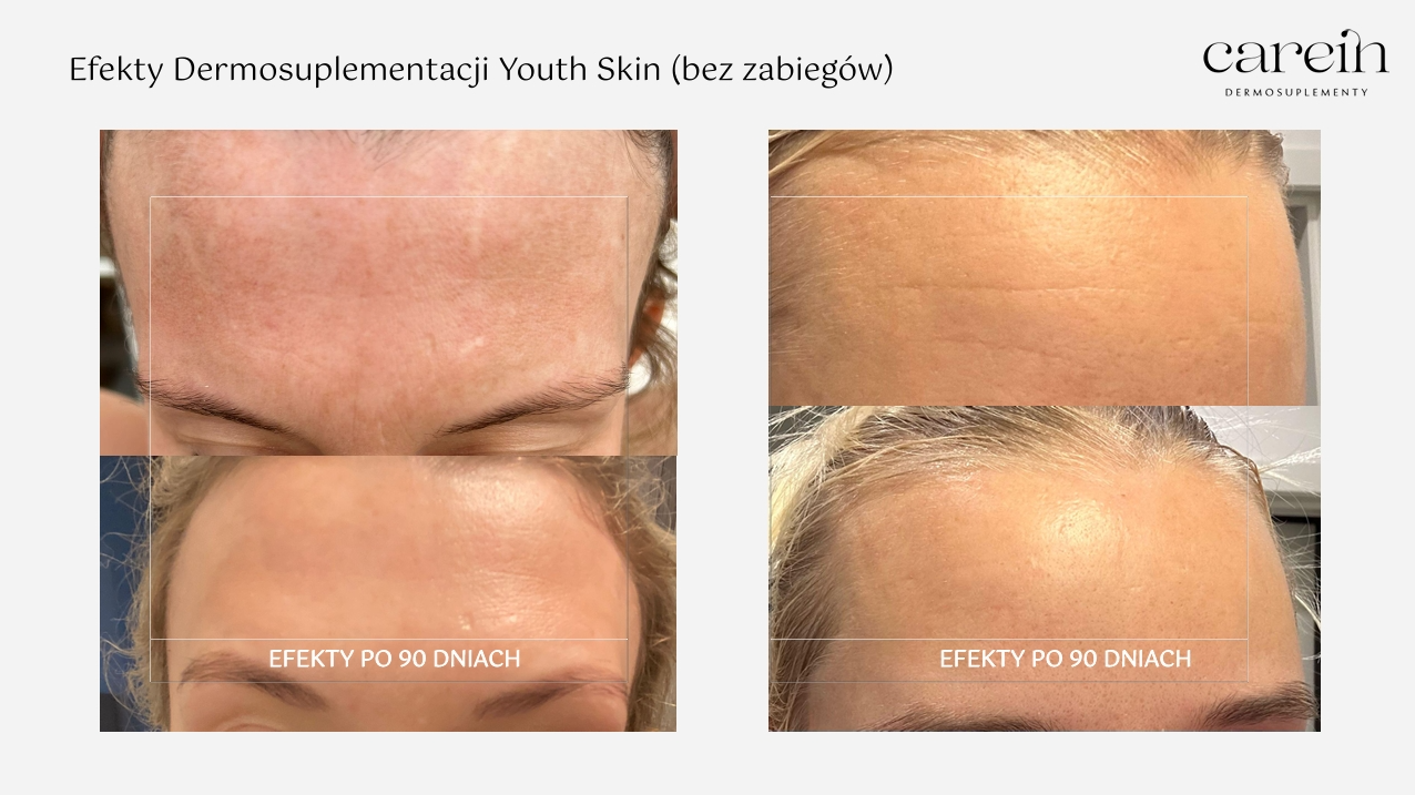 Youth Skin - Efekty bez zabiegów